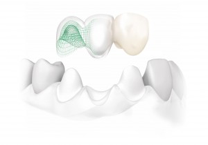NobelProcera-all-ceramic-bridge-on-natural-teeth