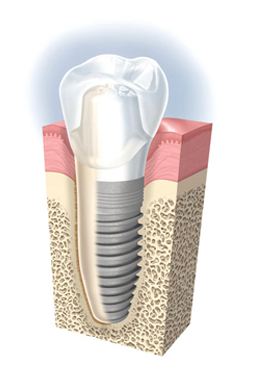 Implant dentaire Caen